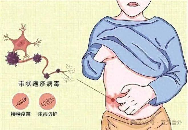 带状疱疹，让你痛不欲生！你知道如何预防吗？  第1张