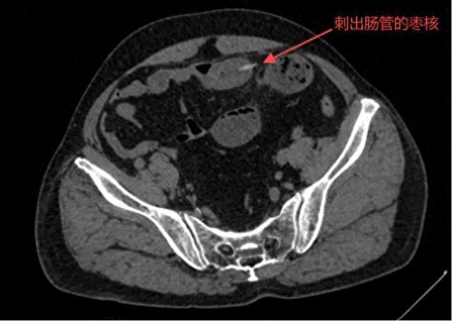 70 多岁老人吃红枣竟险些丧命，你还敢这样吃吗？  第1张