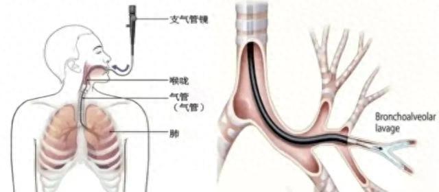 你听说过床旁电子支气管镜吗？它有这些优势  第1张