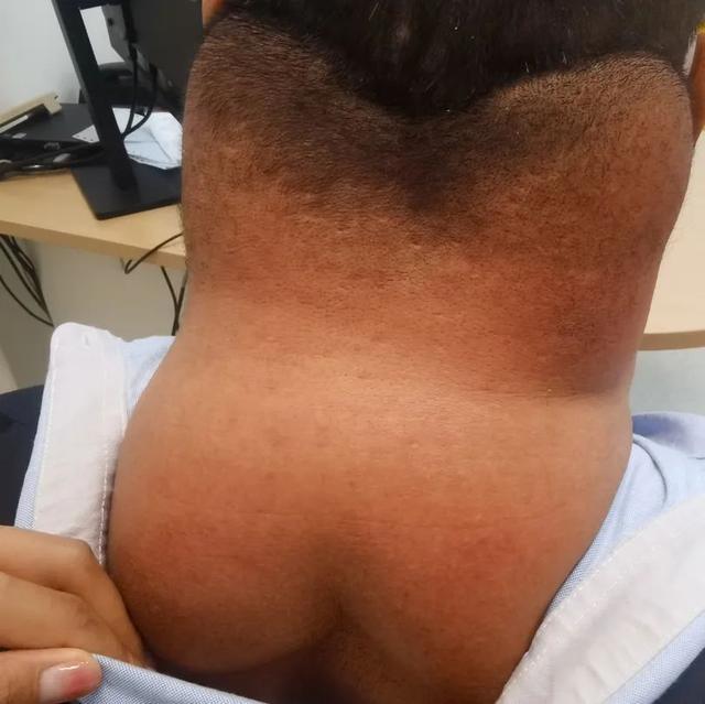 东北汉子每天喝一斤白酒，四十多岁竟变成这样