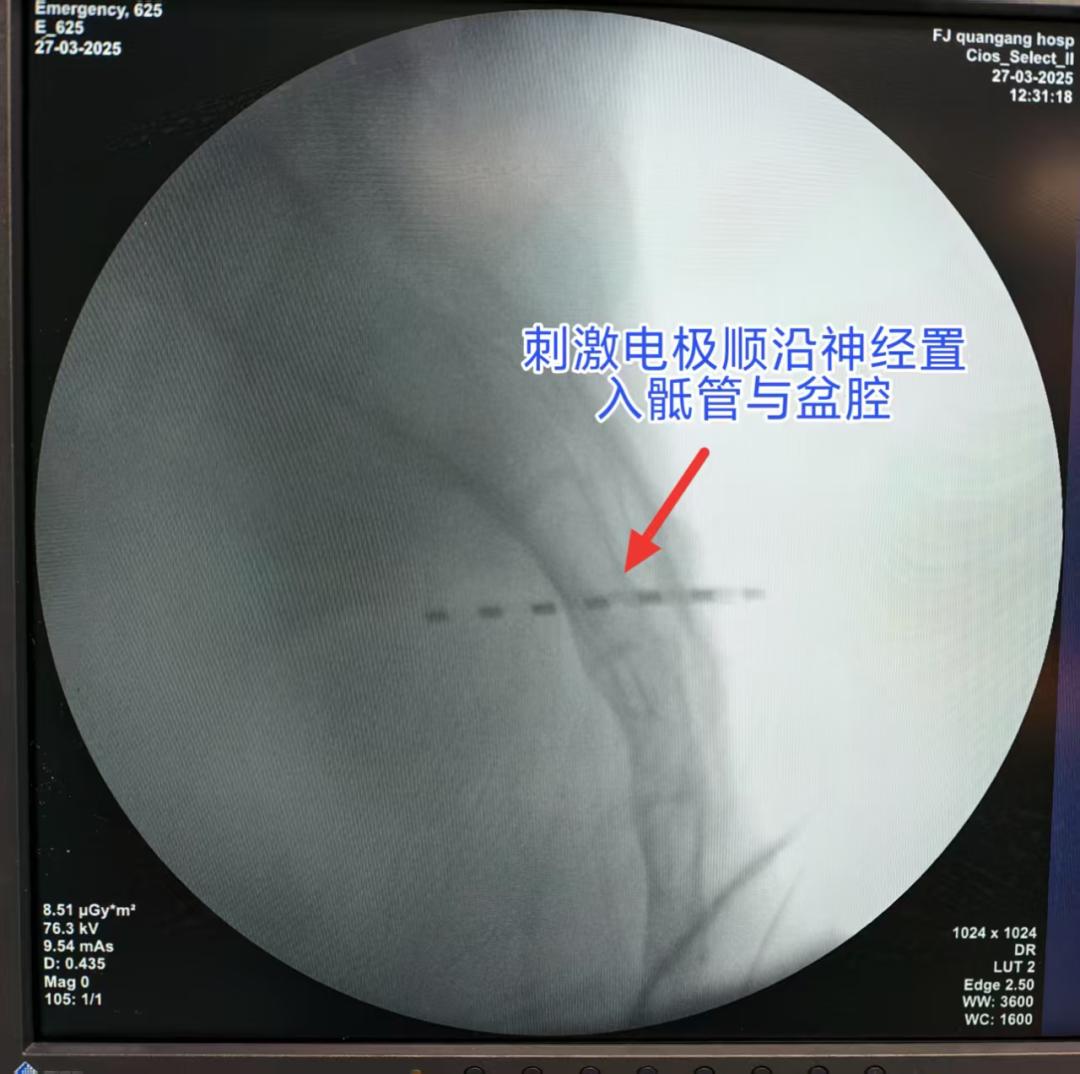 只是摔了一跤竟患尿毒症？这场噩梦般经历究竟咋回事  第2张