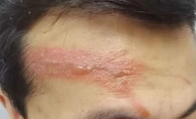 隐翅虫现身杭州！号称会飞的浓硫酸，你还敢随意拍它吗？  第2张