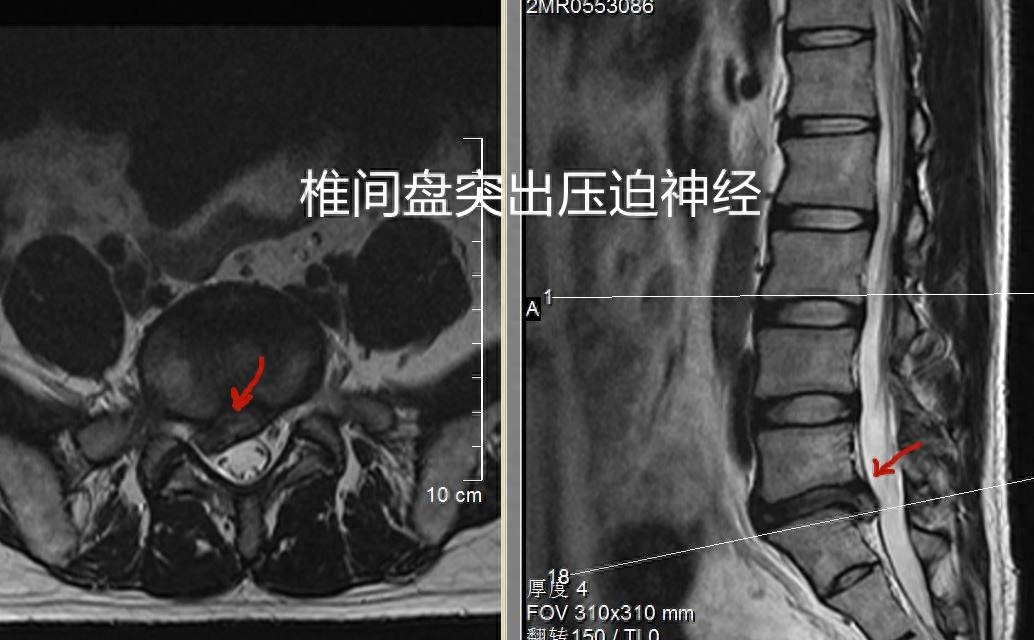 90后厨师腰椎间盘突出，竟因这个原因无法工作！微创手术如何拯救他的职业生涯？