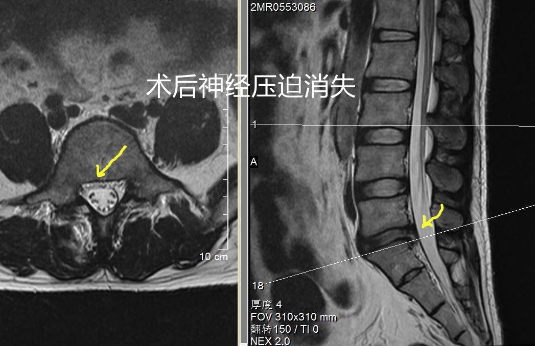 90后厨师腰椎间盘突出，竟因这个原因无法工作！微创手术如何拯救他的职业生涯？  第2张