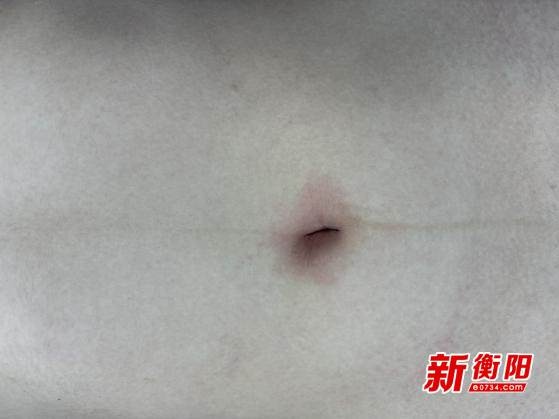 30年前开腹留下疤痕，如今微创手术竟能无痕？衡阳小女孩的手术奇迹  第2张