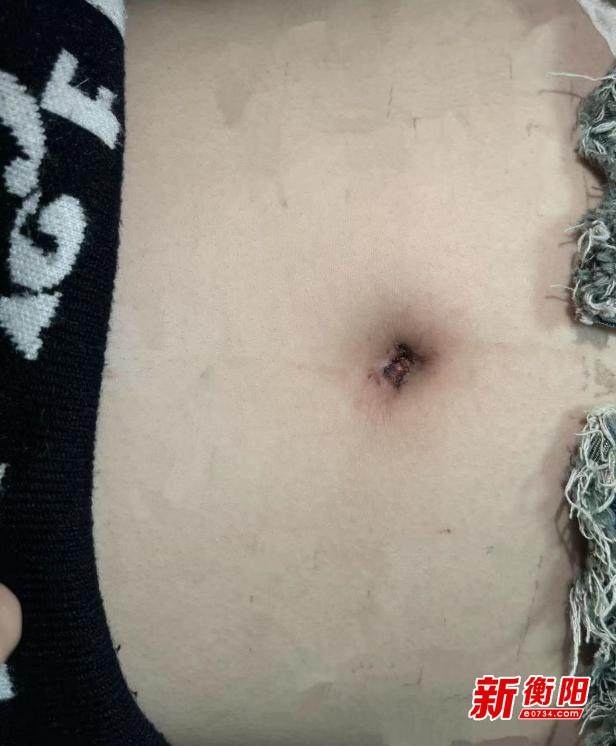 30年前开腹留下疤痕，如今微创手术竟能无痕？衡阳小女孩的手术奇迹  第3张