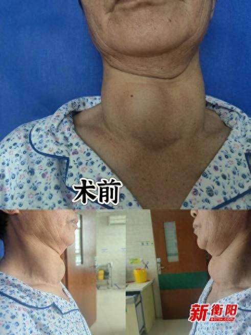 16厘米巨大甲状腺肿瘤竟被成功切除！南华医院是如何创造这一医学奇迹的？