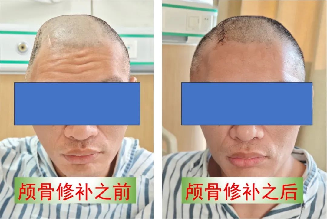 飞来横祸致颅骨缺失，上海市中医医院如何助张先生安心过春节？  第2张