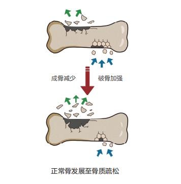 骨质疏松不只是老年人的专利！年轻人如何预防和改善骨骼健康？
