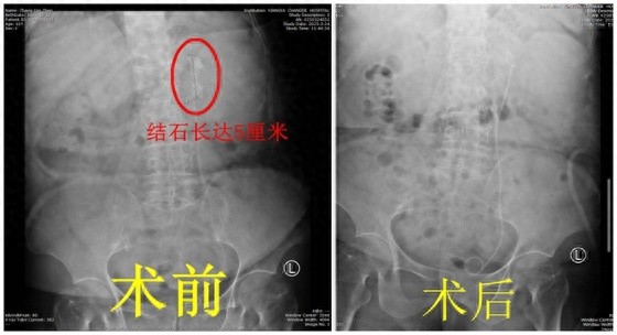 5厘米肾结石，多家医院无解，湘雅常德医院如何妙手回春?