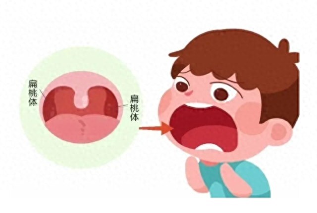孩子鼻塞流涕，你以为只是感冒？小心腺样体肥大影响面容