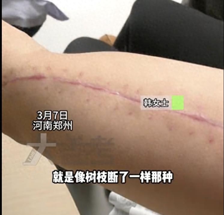 掰手腕竟然会导致骨折？这些惊人案例让你重新认识这项游戏