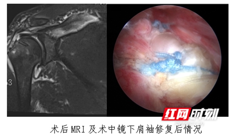 永州市中心医院骨科有多神? 几个小切口解除30多年病痛!  第3张