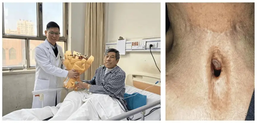 新疆首例无喉患者重获新声！术后3小时发出清晰第一声，你相信奇迹吗？  第2张