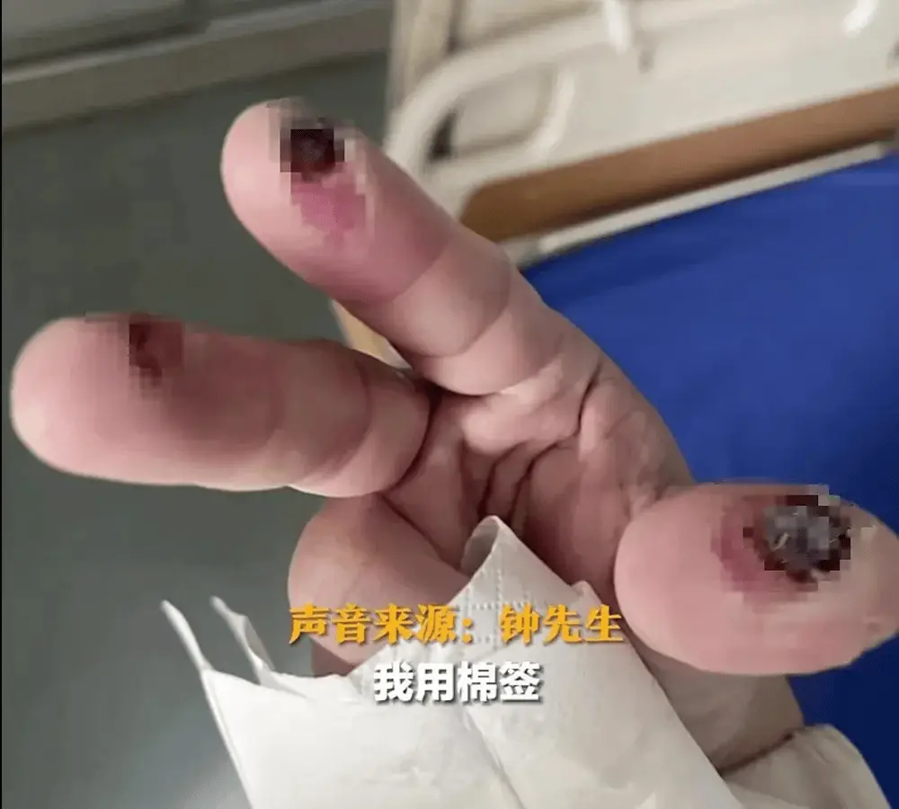 春节大扫除小心！男子三根手指被腐蚀出黑洞，氢氟酸究竟有多危险？