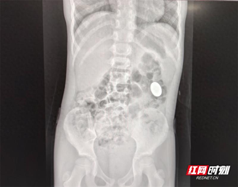 8岁儿童误吞硬币，三分钟内无痛取出！郴州四院如何做到的？  第1张