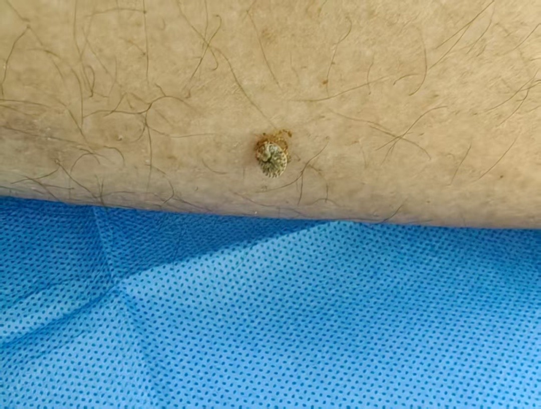 春日采茶竟遇隐形杀手蜱虫！假期出游踏青如何提防这夺命寄生虫？