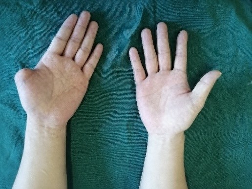 奇迹！8个月后他的拇指竟然失而复得，医生是怎么做到的？