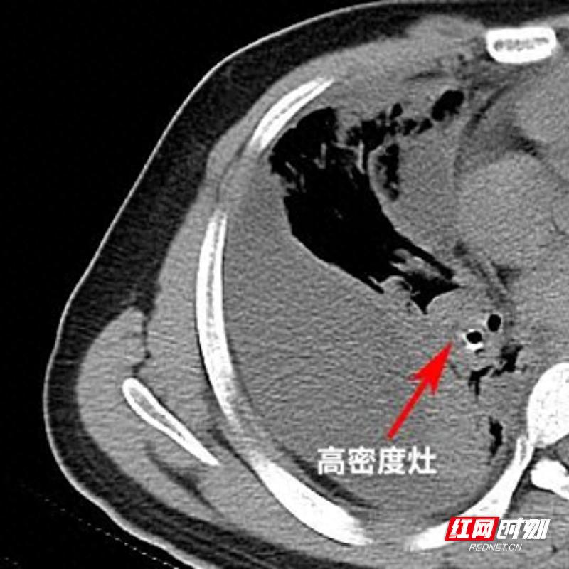20岁男子每月发烧竟因10年前误吞圆珠笔帽！你的孩子也可能在危险中
