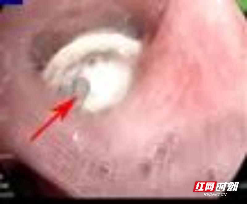 20岁男子每月发烧竟因10年前误吞圆珠笔帽！你的孩子也可能在危险中  第2张