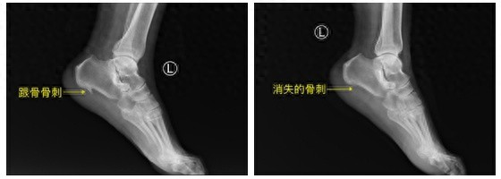 中南湘雅常德病区关节镜技术攻克十年顽疾，骨科微创再破新高？