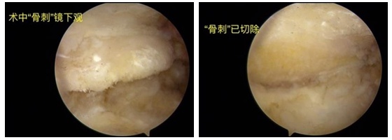 中南湘雅常德病区关节镜技术攻克十年顽疾，骨科微创再破新高？  第2张