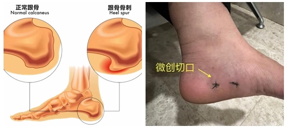 中南湘雅常德病区关节镜技术攻克十年顽疾，骨科微创再破新高？  第3张