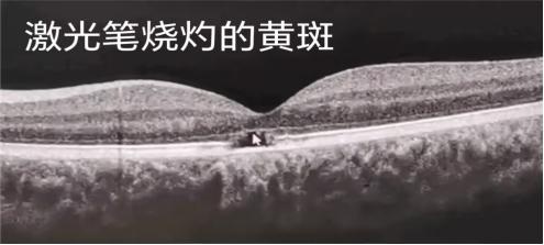 仅几秒照射，13岁男孩右眼视力骤降至0.05！激光笔的隐藏危险你了解吗？  第3张