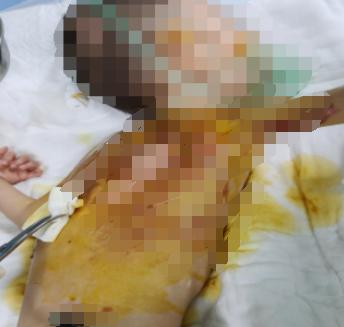 电吹风暖背竟让5岁男童深度烧伤！这种‘偏方’你还敢用吗？  第2张