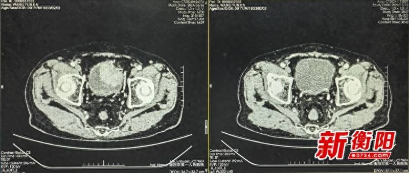 91岁高龄老人膀胱肿瘤奇迹消失！衡阳市第一人民医院如何做到的？