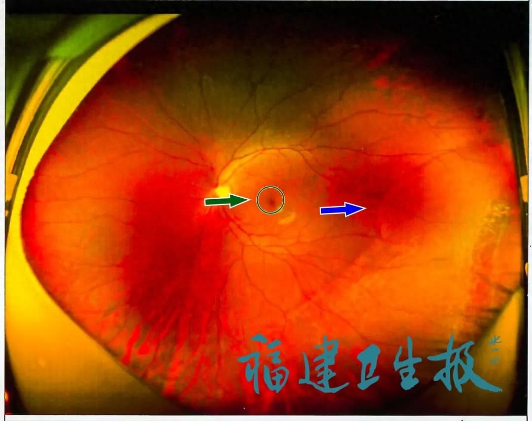 高三学生配镜矫正视力 1.0 后却被要求进一步检查，究竟为何？