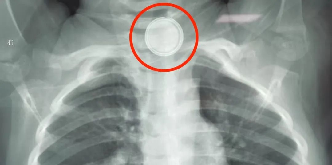 2岁女童食道惊现致命纽扣电池！家长必看，这些危险物品你家有吗？  第3张
