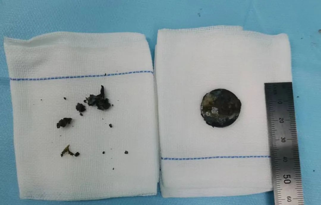 2岁女童食道惊现致命纽扣电池！家长必看，这些危险物品你家有吗？  第5张