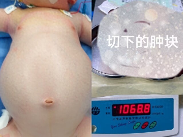 27天新生儿体内竟藏两斤重肿瘤！家长忽视的胀气竟是致命危机？  第1张