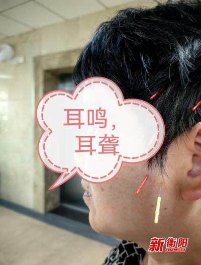 饱受耳鸣折磨3年？南华医院颊针疗法带来新希望