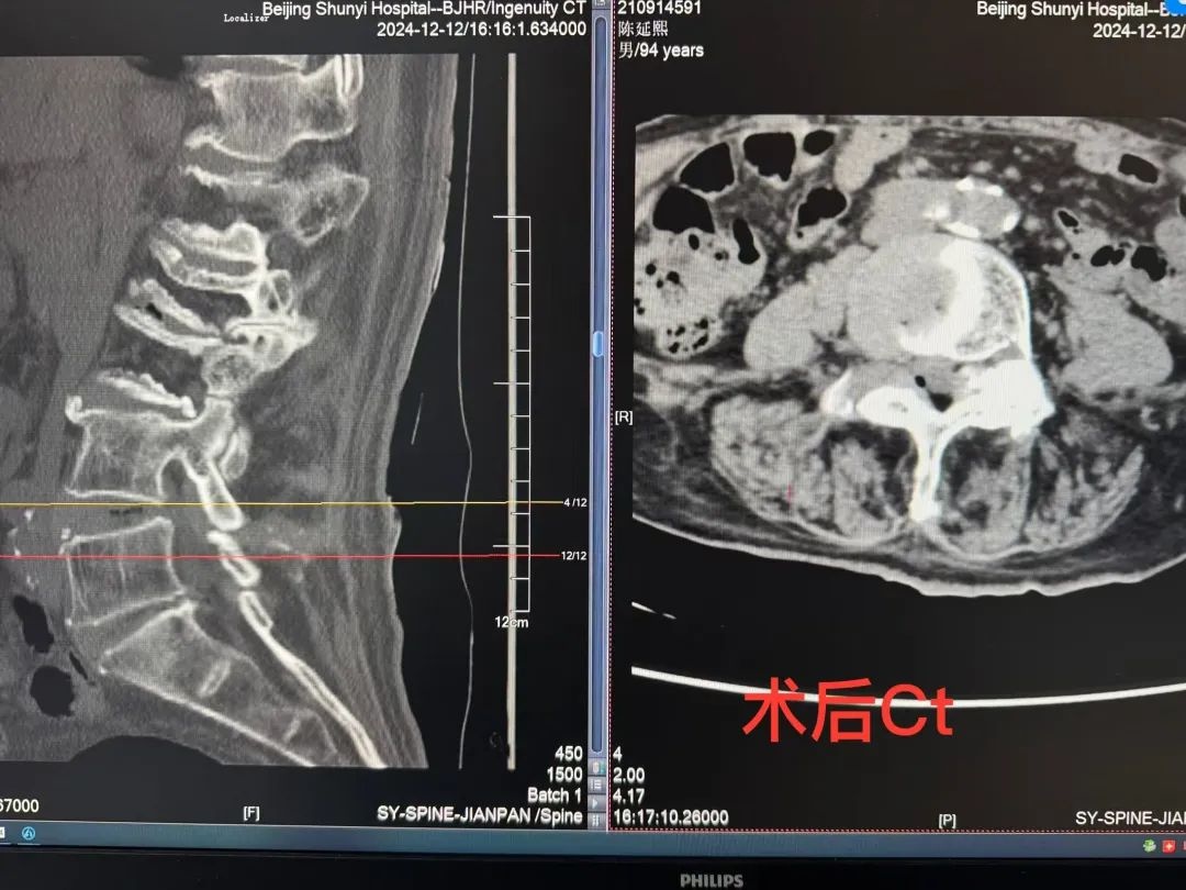 94岁高龄老人成功手术，腰椎管狭窄症如何被攻克？术后康复奇迹揭秘  第2张
