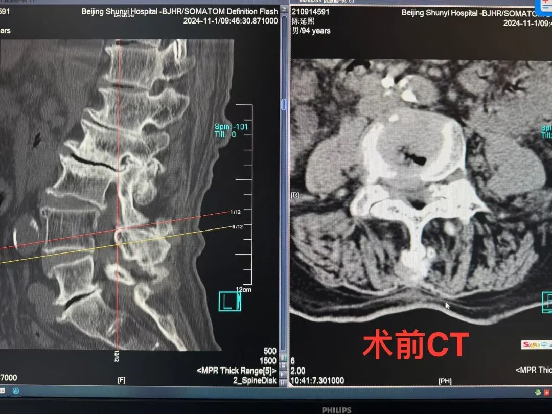 94岁高龄老人成功手术，腰椎管狭窄症如何被攻克？术后康复奇迹揭秘  第3张