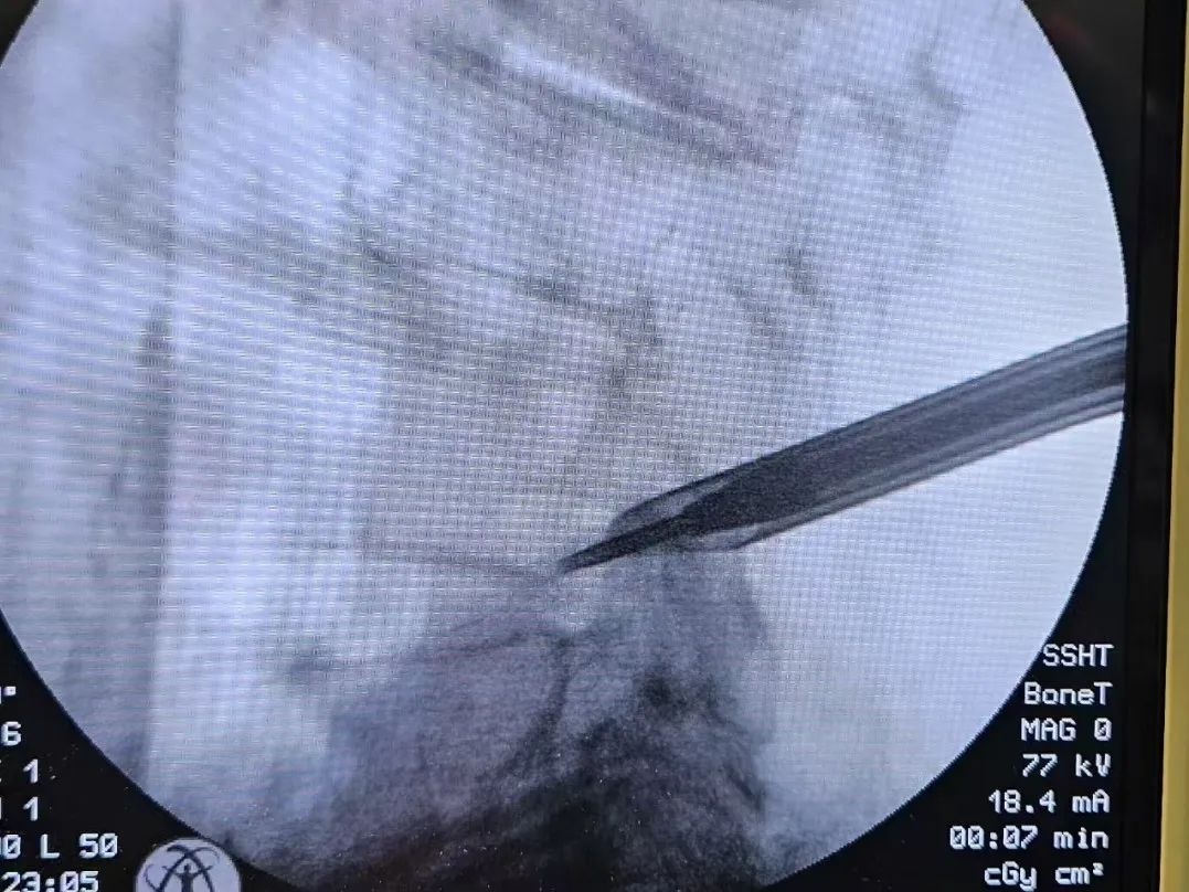 94岁高龄老人成功手术，腰椎管狭窄症如何被攻克？术后康复奇迹揭秘  第4张