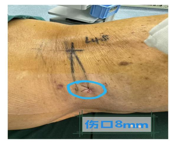 94岁高龄老人成功手术，腰椎管狭窄症如何被攻克？术后康复奇迹揭秘  第6张