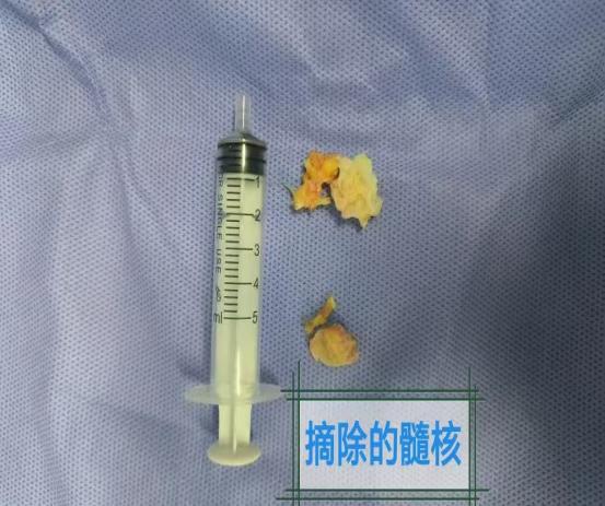 94岁高龄老人成功手术，腰椎管狭窄症如何被攻克？术后康复奇迹揭秘  第7张