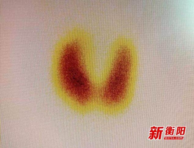 甲亢患者苦寻良方无果，南华医院核医学科能否妙手回春？  第2张