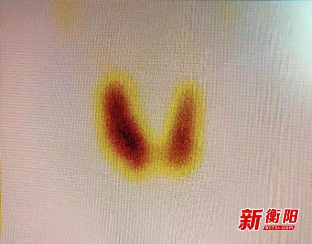 甲亢患者苦寻良方无果，南华医院核医学科能否妙手回春？  第3张