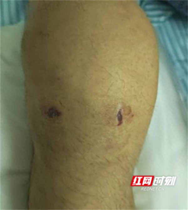 九年顽疾终破解！永州医生如何揪出关节肿痛的‘隐形杀手’？