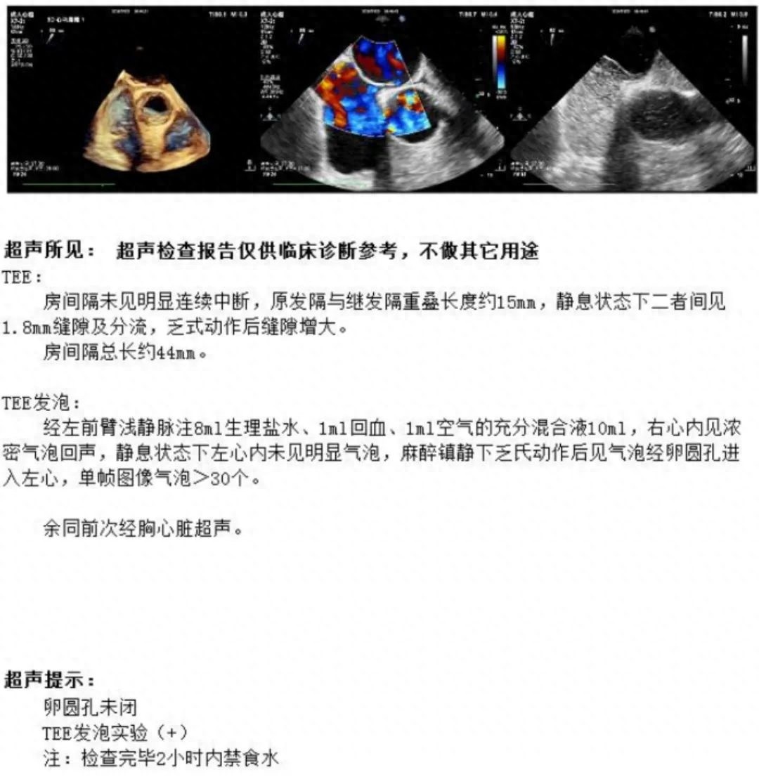 头痛竟医心，十堰首例可消失封堵器手术，小心眼难题解决了