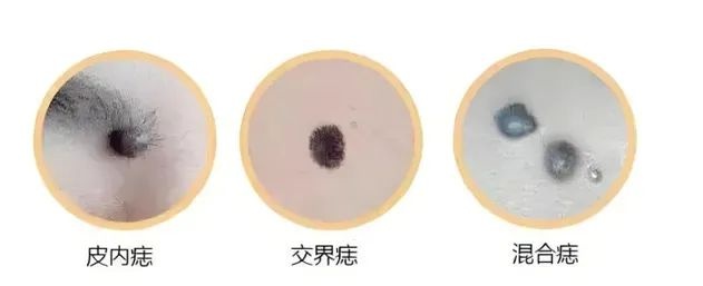 你身上的这颗痣可能是致命隐患！如何自查并避免悲剧发生？  第2张