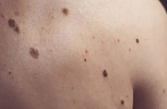 你身上的这颗痣可能是致命隐患！如何自查并避免悲剧发生？  第3张