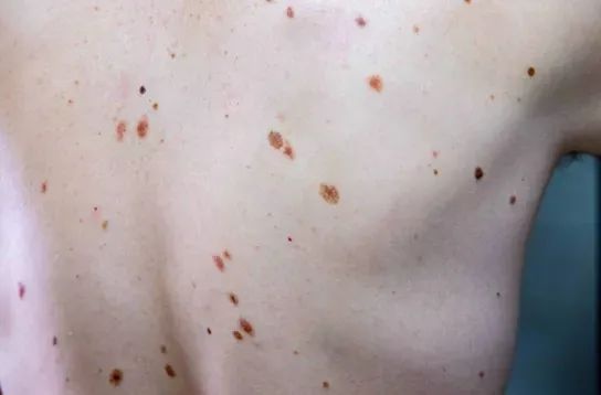 你身上的这颗痣可能是致命隐患！如何自查并避免悲剧发生？  第4张