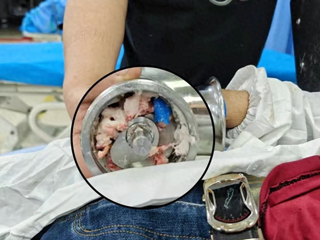 惊悚！漳州第三医院惊现人肉绞肉机事故？伤者右手竟被绞至毁损