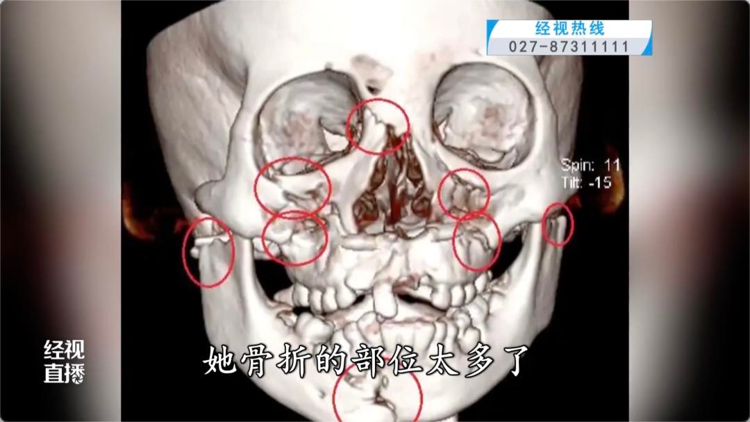 8岁女童骑车跌落命悬一线！牙齿呛入支气管如何化险为夷？  第3张