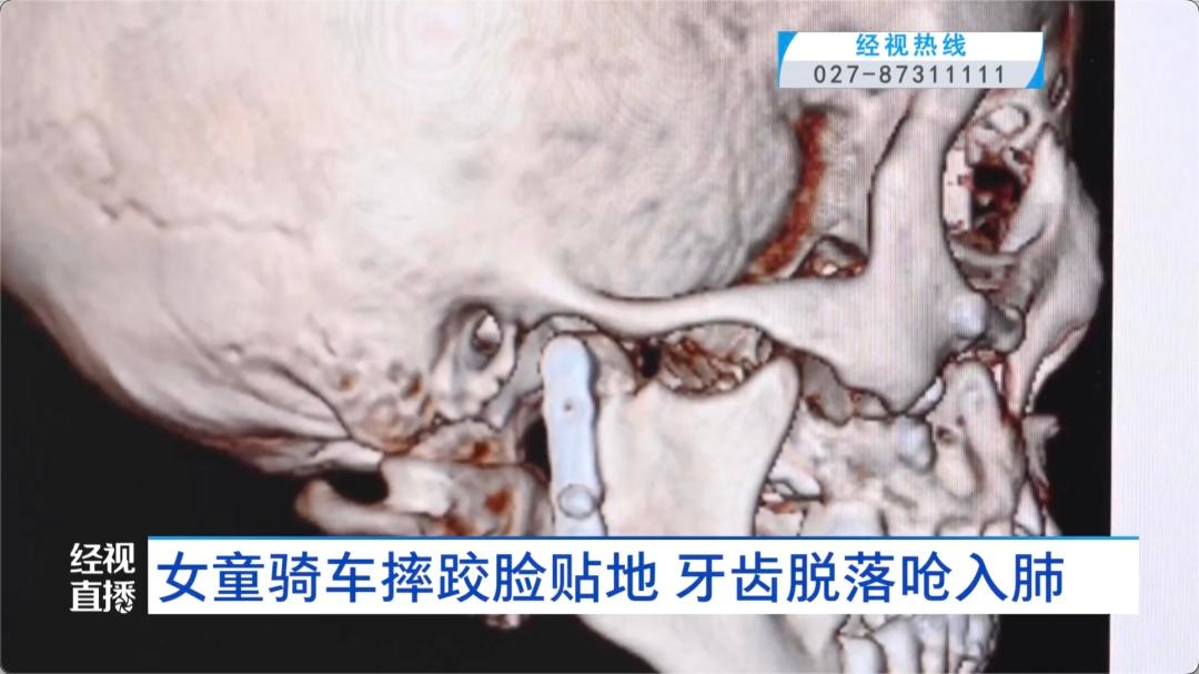 8岁女童骑车跌落命悬一线！牙齿呛入支气管如何化险为夷？  第4张
